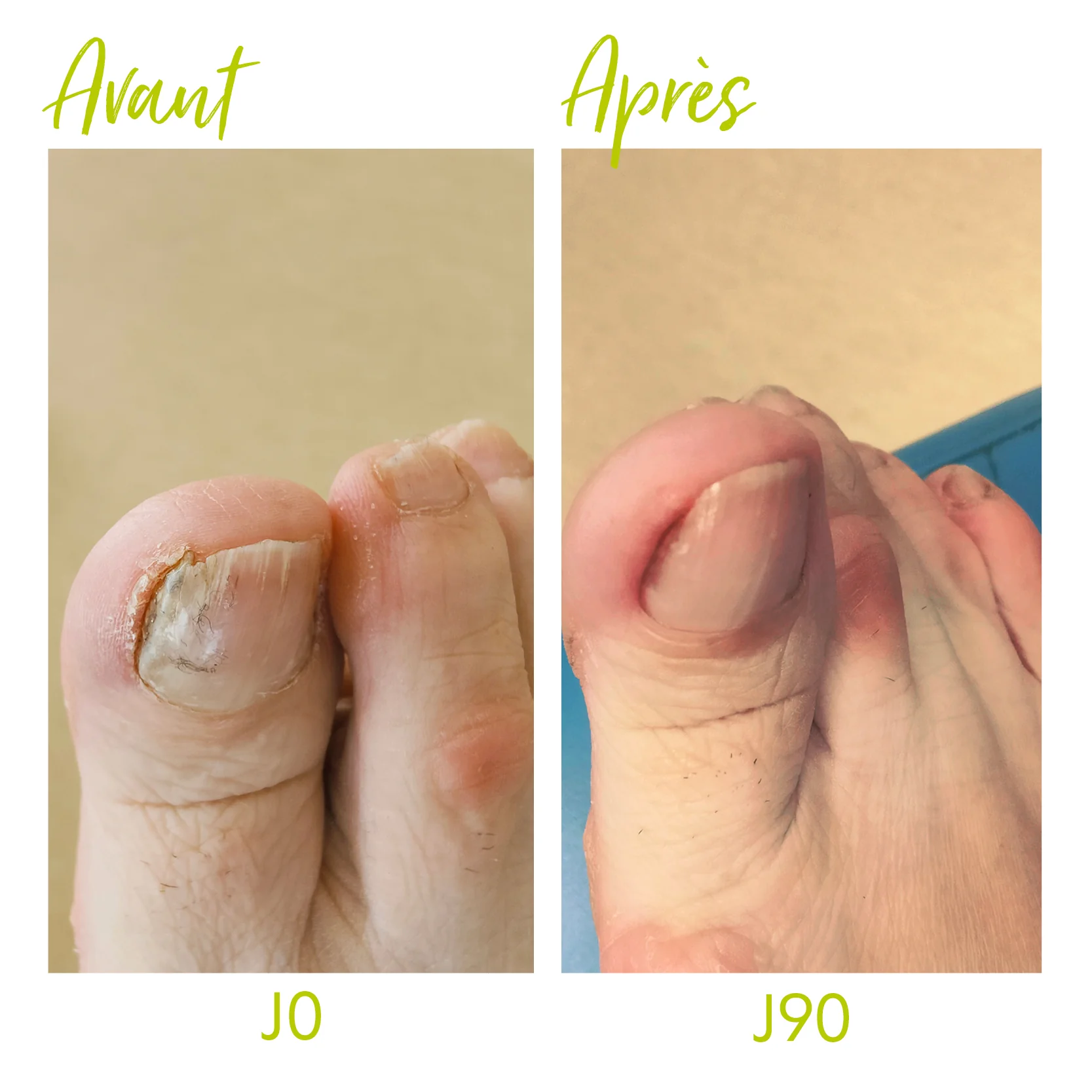 Ongles jaunis, abîmés - Image 3